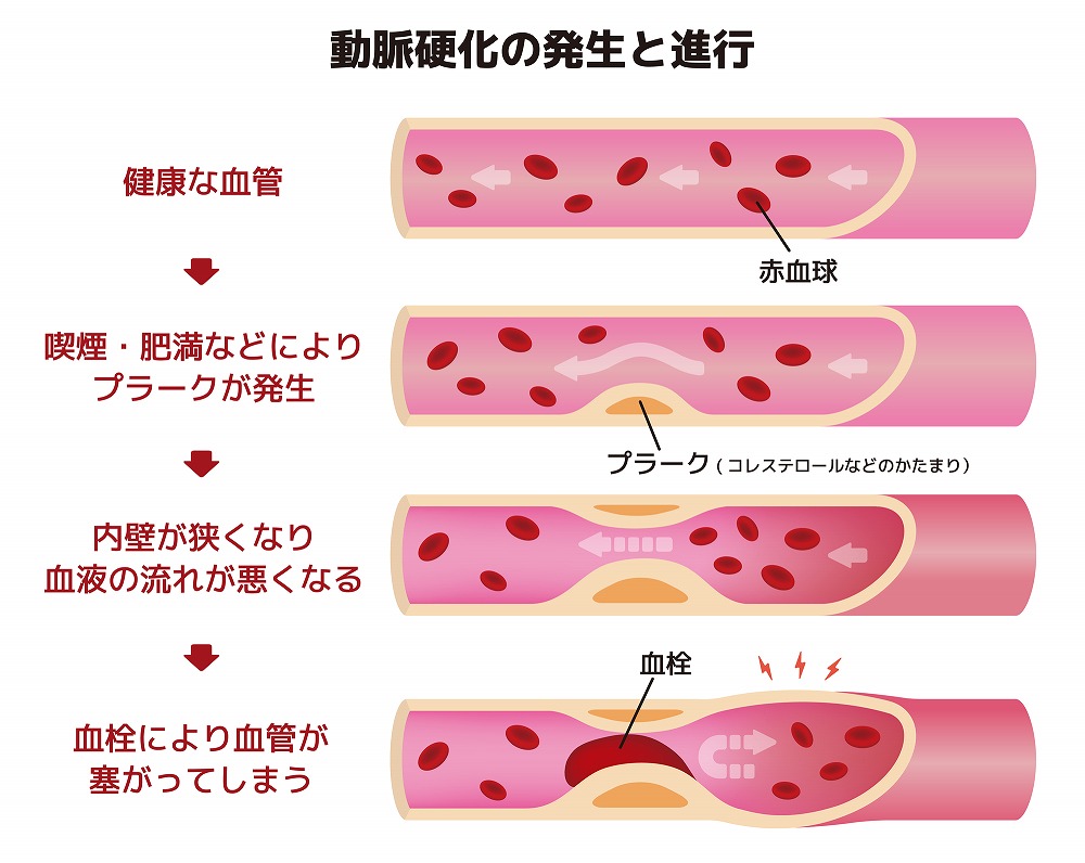 動脈硬化とは