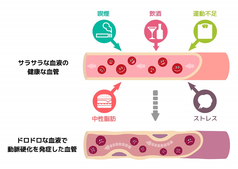 動脈硬化の原因